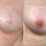 Micropigmentación reconstructiva