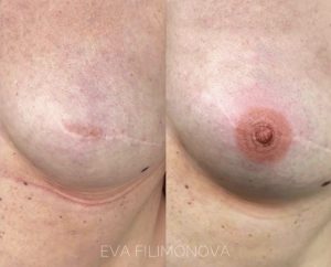 Micropigmentación reconstructiva