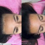 Micropigmentación capilar