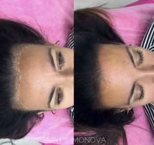 Micropigmentación capilar