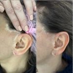 Micropigmentación médica