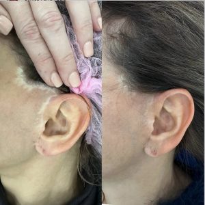 Micropigmentación médica