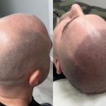 Micropigmentación capilar