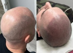 Micropigmentación capilar