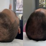 Micropigmentación capilar