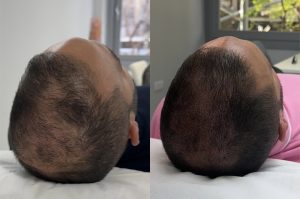 Micropigmentación capilar